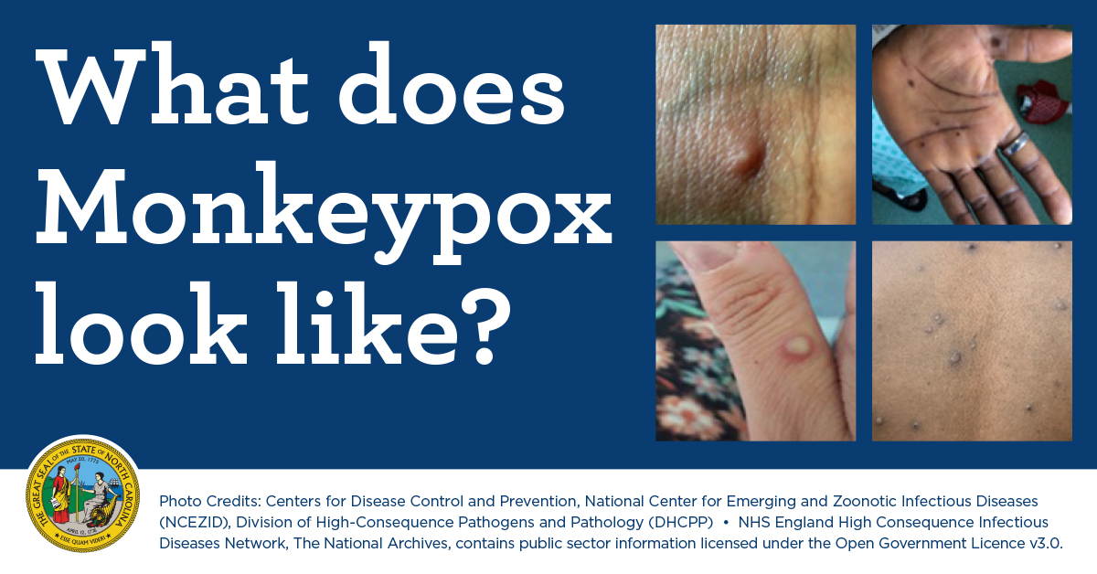 pictures of monkeypox on skin